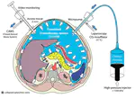 PIPAC (Pressurized intraperitoneal aerosol chemotherapy)