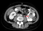 Neutropene Enterokolitis