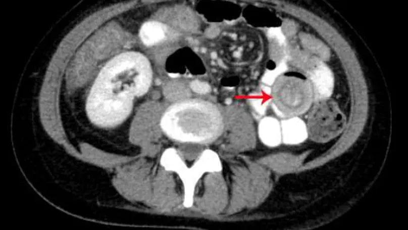 Neutropene Enterokolitis