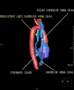 Persistierende linke Vena cava superior